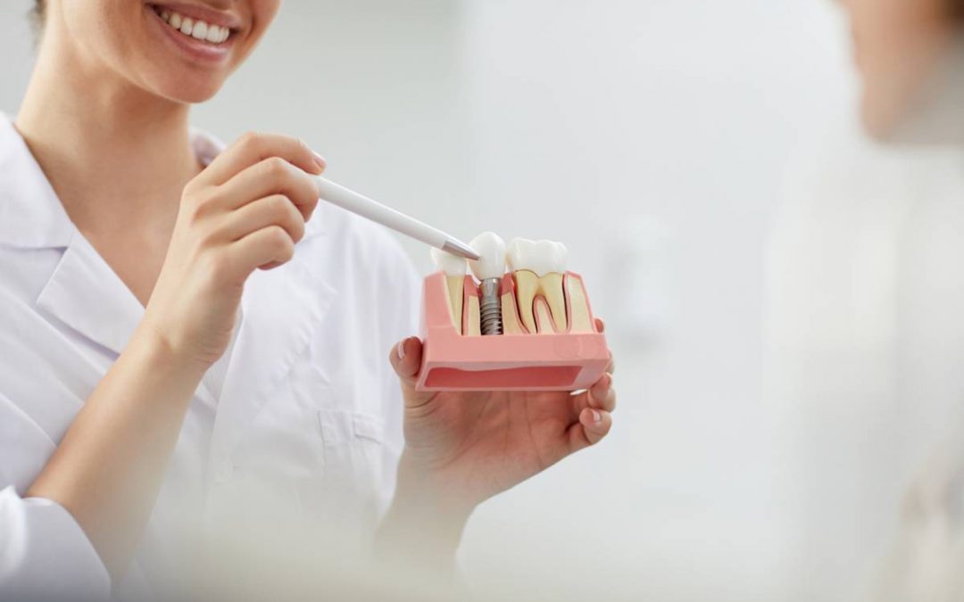 Implants dentaires : comment choisir l’expert ?