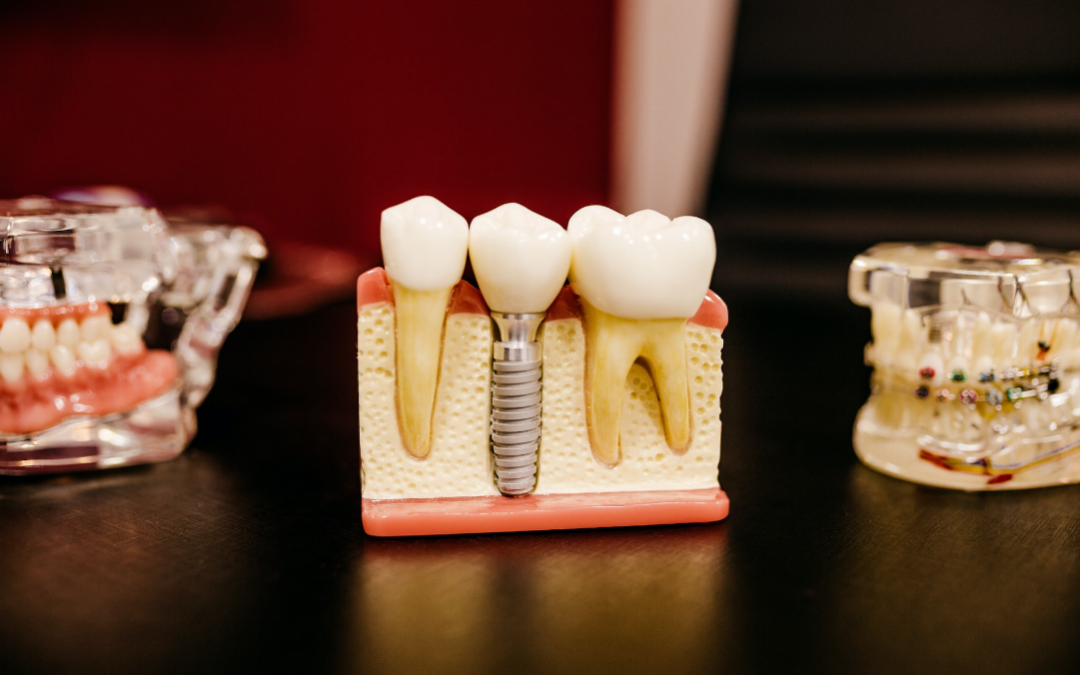 Beneficiez d’implants dentaires plus rapides : l’alternative a considerer
